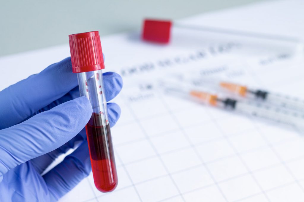 Tratamento Câncer de Próstata Goiânia - Exame de PSA para identificar o câncer de próstata