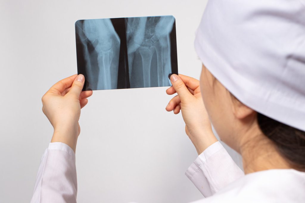 Clinica Ortopédica Goiânia - Quais os tipos de fratura de fêmur?