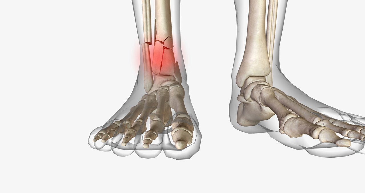 Ortopedia Goiânia - Quais os tratamentos para fratura do tornozelo