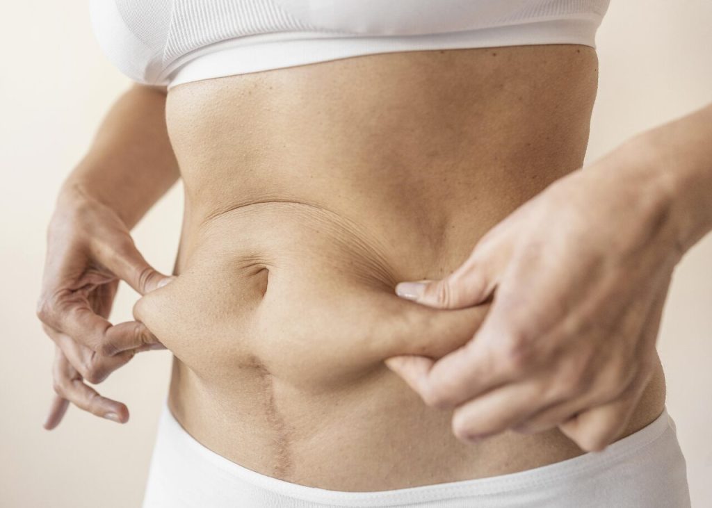 Cirurgia Plástica Goiânia - Qual cirurgia plástica é indicada após grande perda de peso
