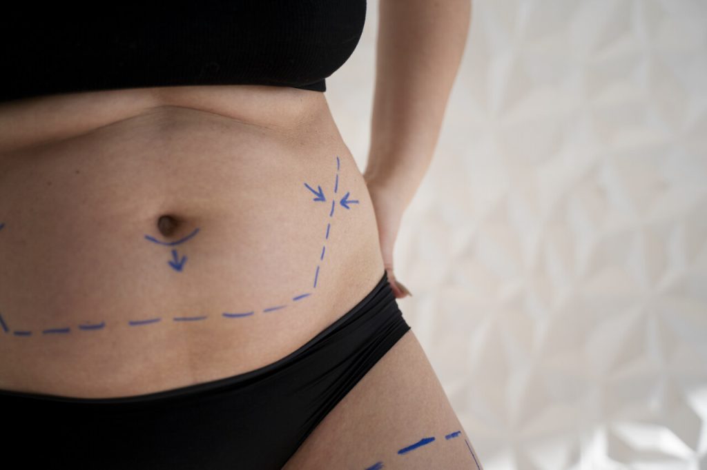 Cirurgia Plástica Goiânia - Tipos de abdominoplastias conheça as técnicas mais modernas!