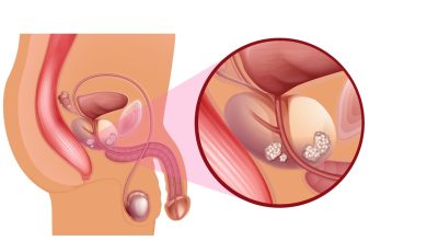 Urologia Goiânia - Novembro Azul - Cuide-se e previna-se contra o câncer de próstata!