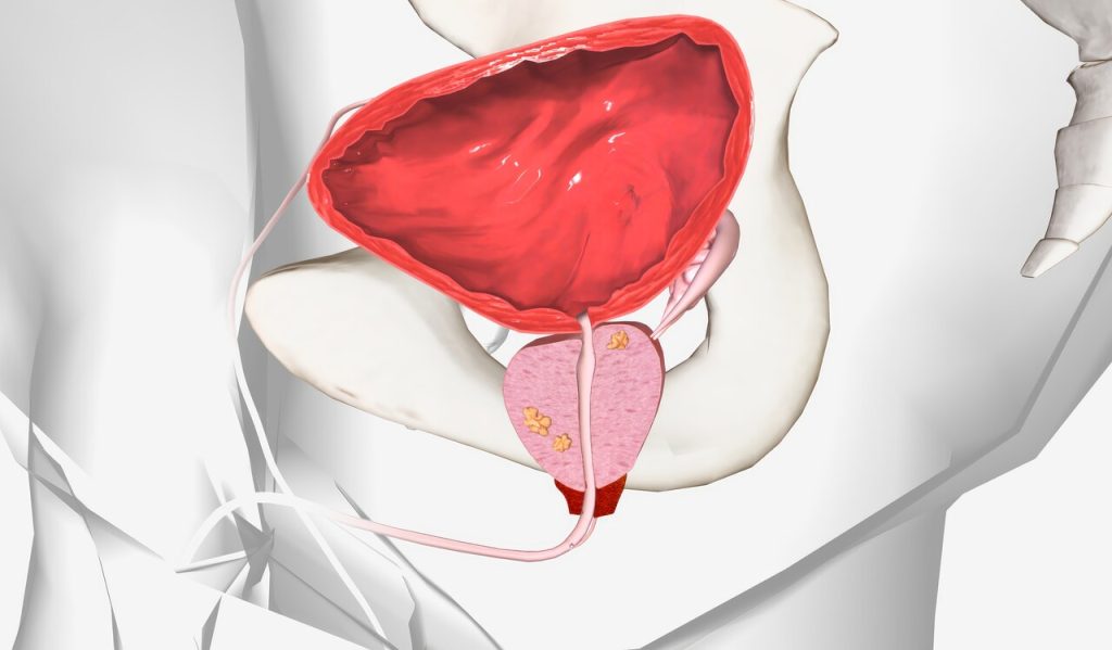 Urologia Goiânia - Diagnóstico precoce é fundamental para aumentar as chances de cura do câncer de próstata!