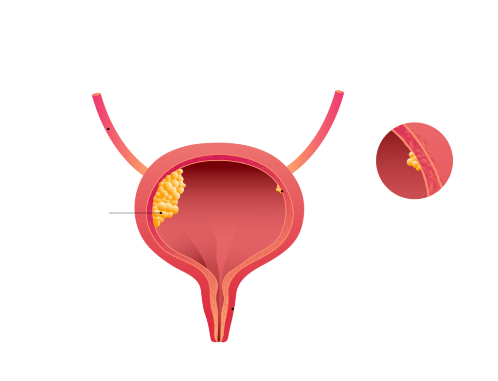 Urologia Goiânia - Por que a prostatectomia radical robótica é tão eficaz?