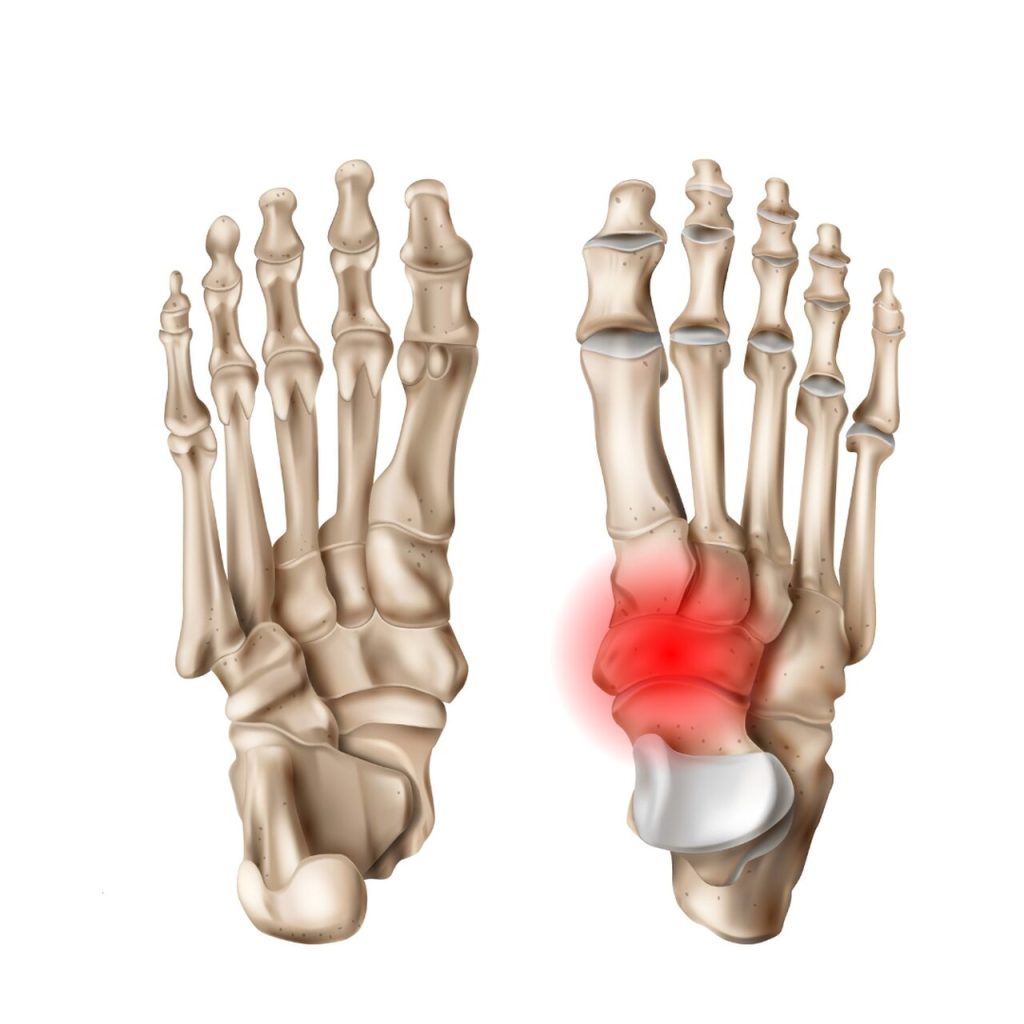 Ortopedia Goiânia - Você sabe o que é Navicular Acessório?