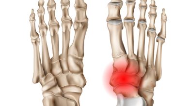 Ortopedia Goiânia - Você sabe o que é Navicular Acessório?