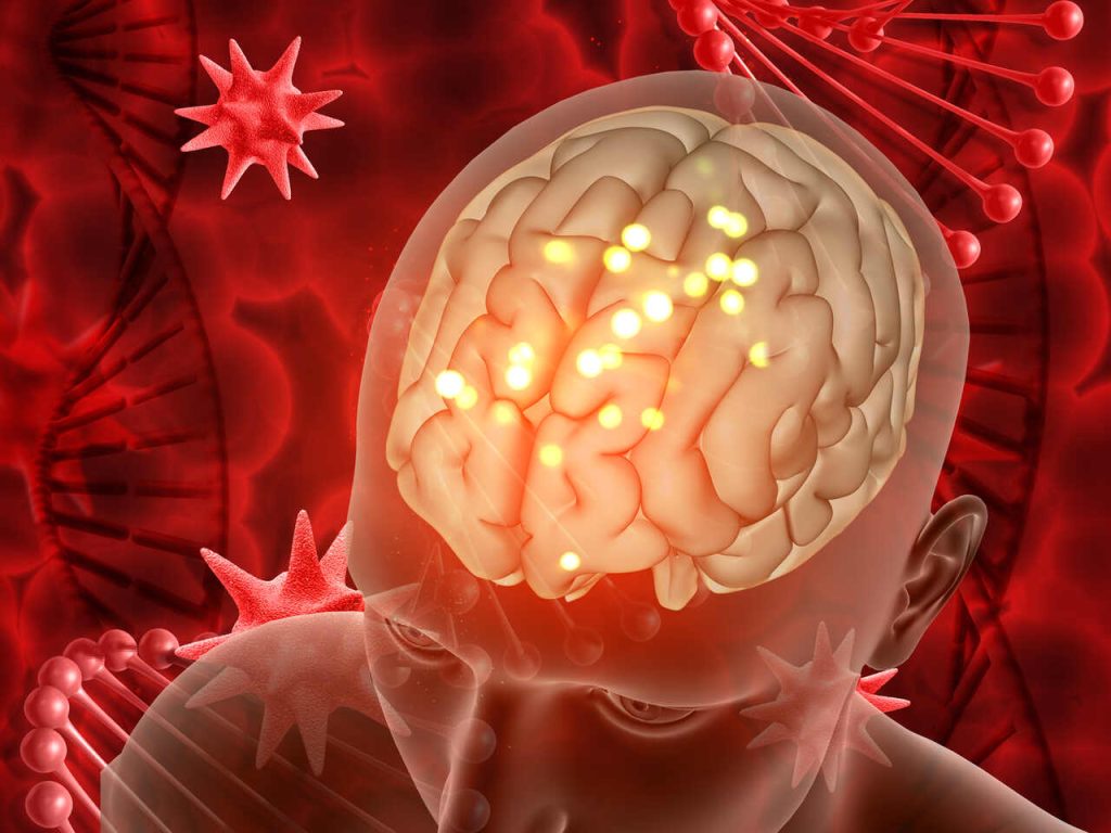 Hospital São Silvestre Aparecida de Goiânia - O que é aneurisma cerebral?