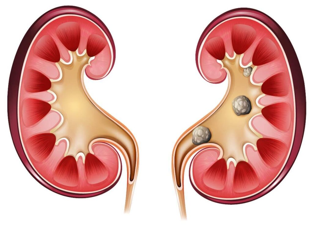Ureterorrenolitotripsia rígida: conheça os benefícios dessa cirurgia