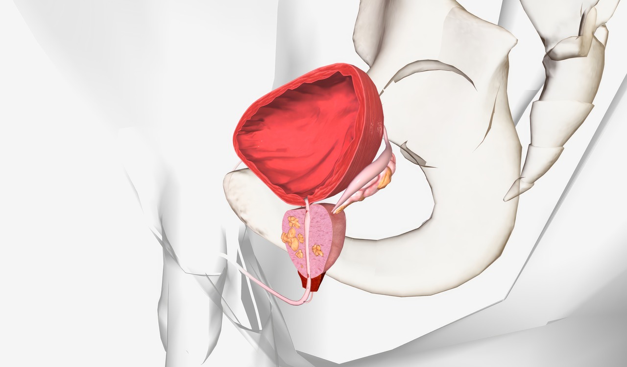 Urologia Aparecida de Goiânia - Quando a prostatectomia radical é indicada?