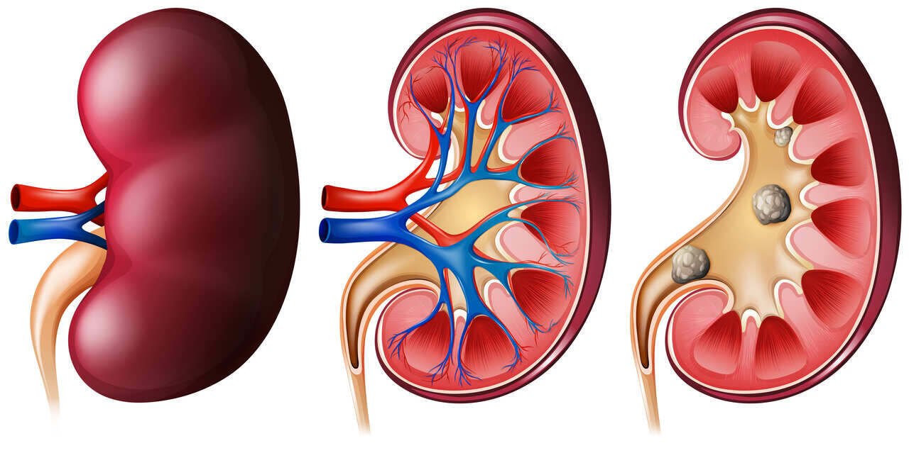 Urologia Goiânia - Cálculo ureteral: sintomas e tratamentos