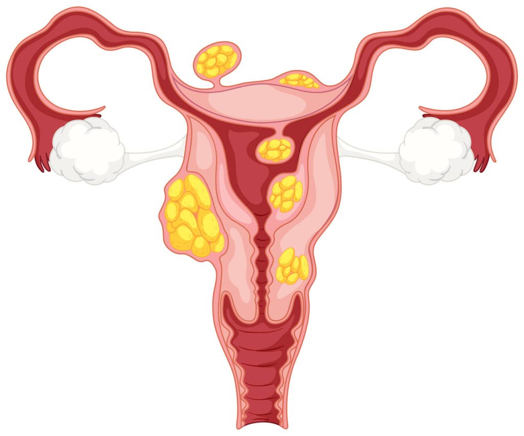 Miomas uterino qual tipo de ultrassom fazer