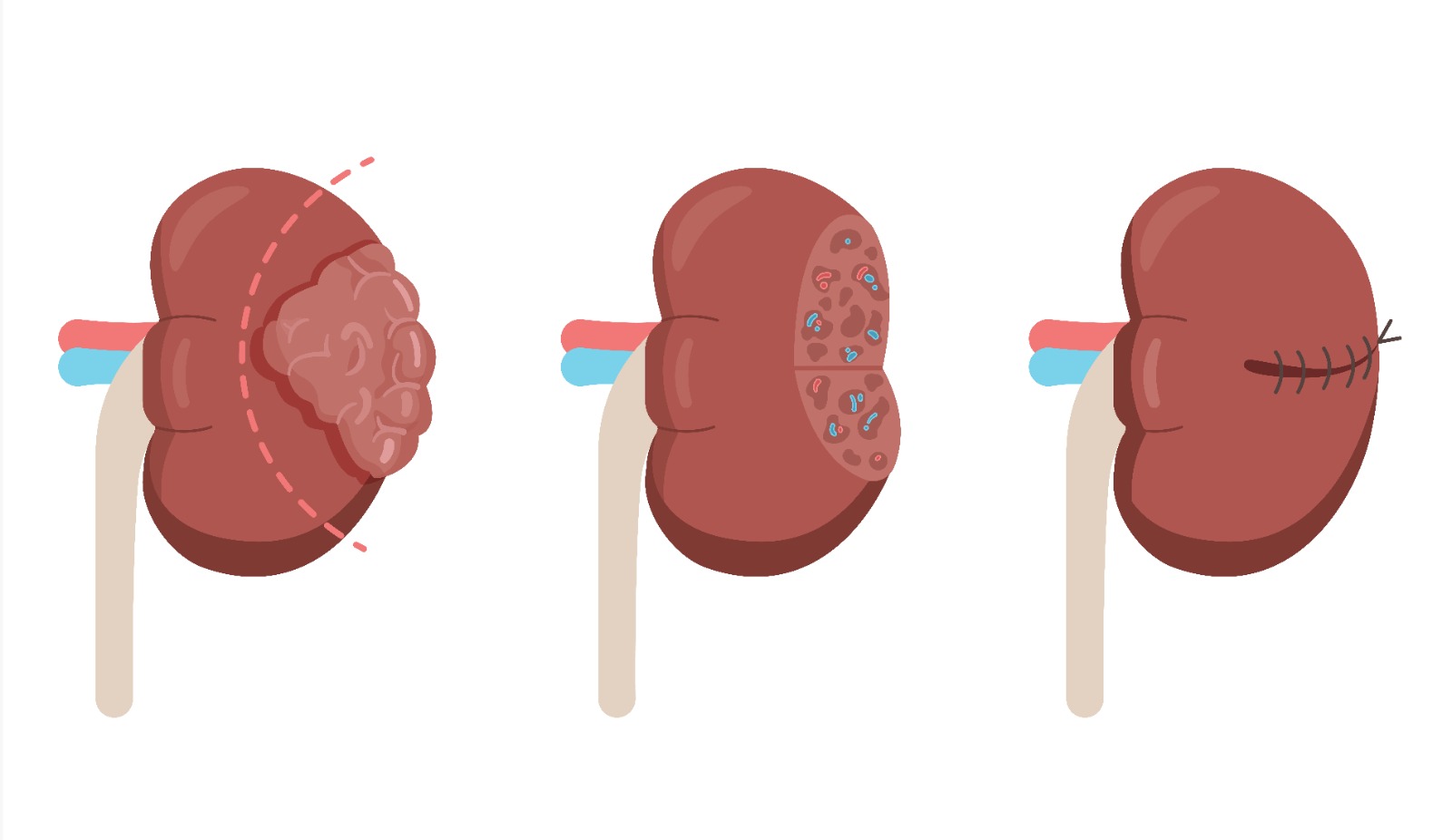 Urologia Goiânia - Nefrectomia parcial por cirurgia robótica