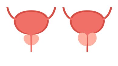 Urologia Goiânia - Como é feita a cirurgia ressecção transuretral da próstata?