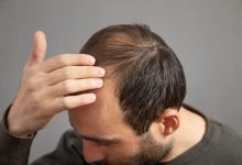 Hospital Aparecida de Goiânia - O que causa a alopecia?