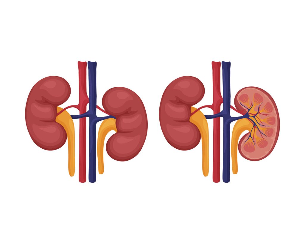 Urologista Goiânia - Quais são os sintomas de tumor nos rins?