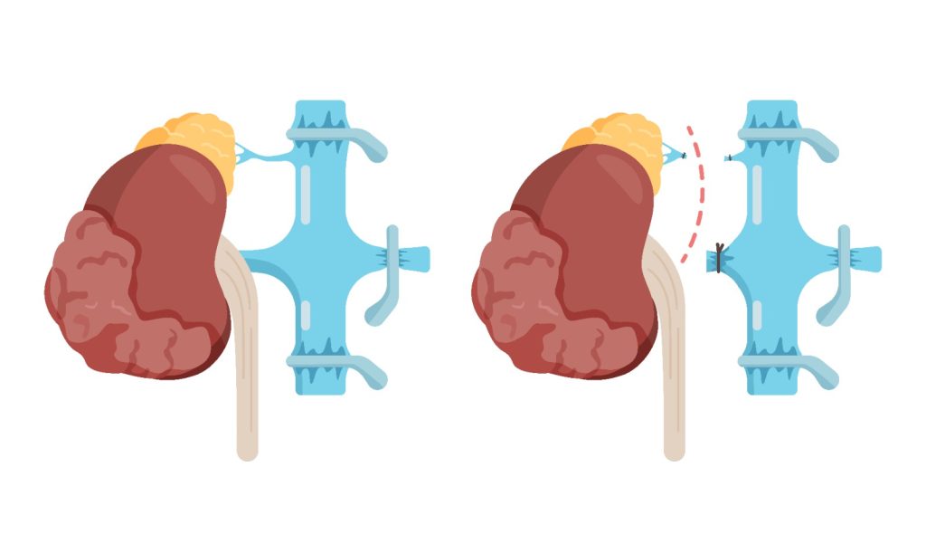 Urologia Aparecida de Goiânia - Conheça os tipos de nefrectomia