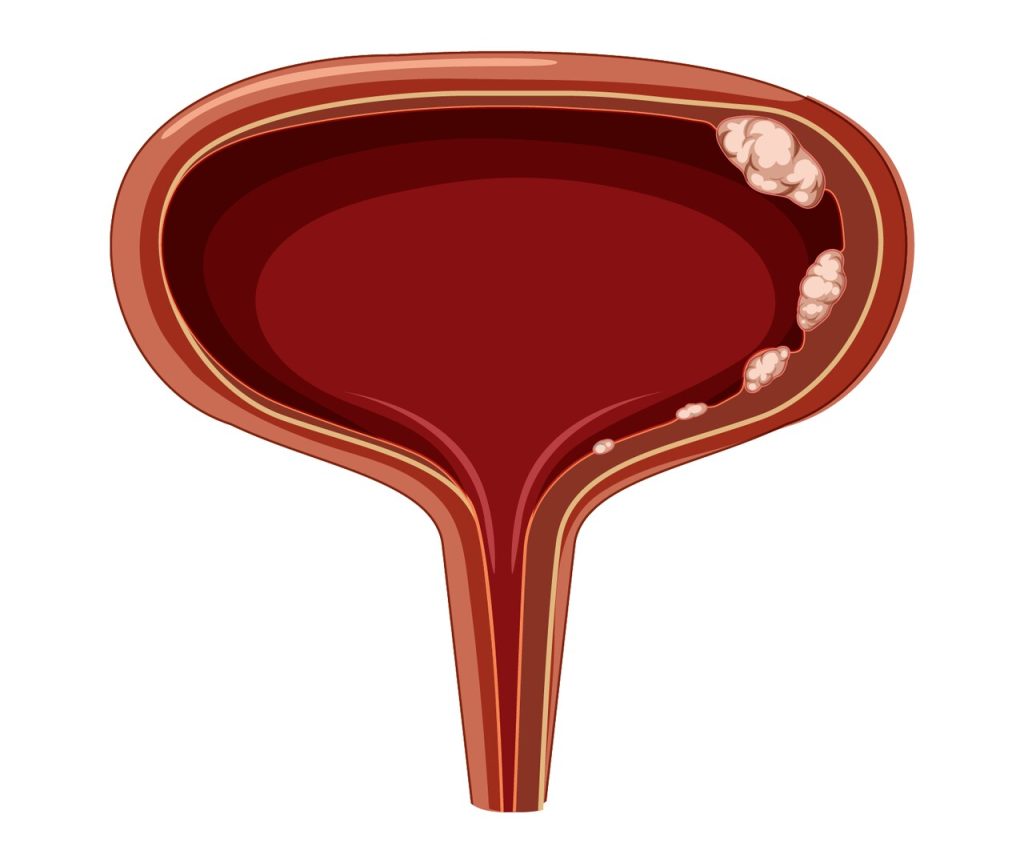 Urologista Goiânia - Cuidados essenciais após a RTU de bexiga