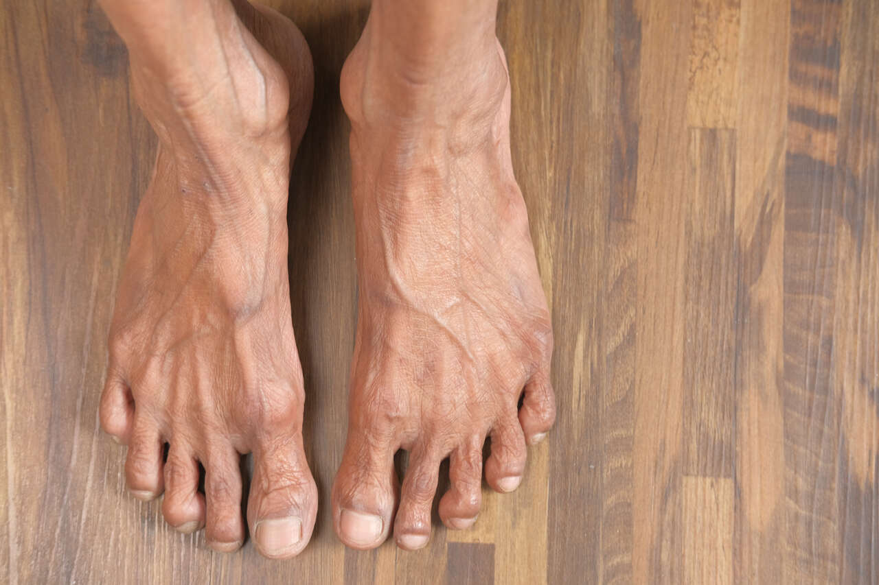 Lar para Idosos Goiânia - Cuidados essenciais a ter com os pés dos idosos