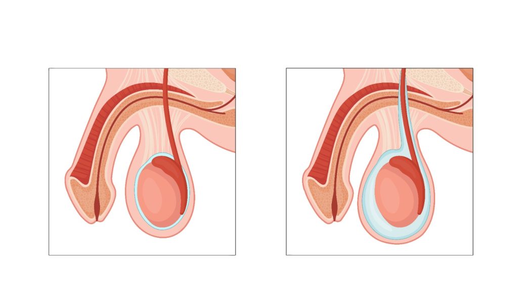 Urologia Goiânia - Qual o tratamento cirúrgico da hidrocele?