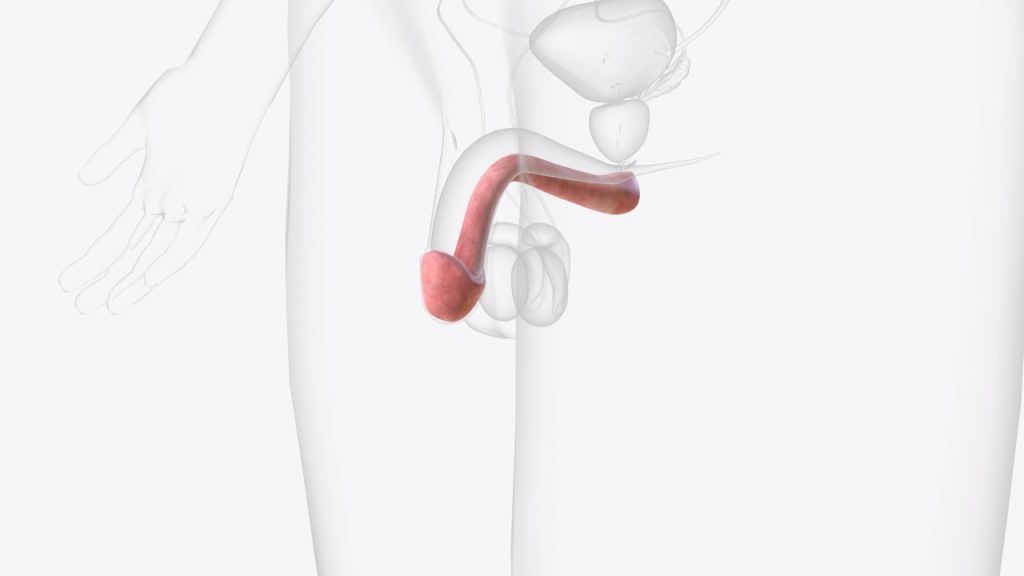 Urologia Goiânia - Doença de Peyronie: como tratar?