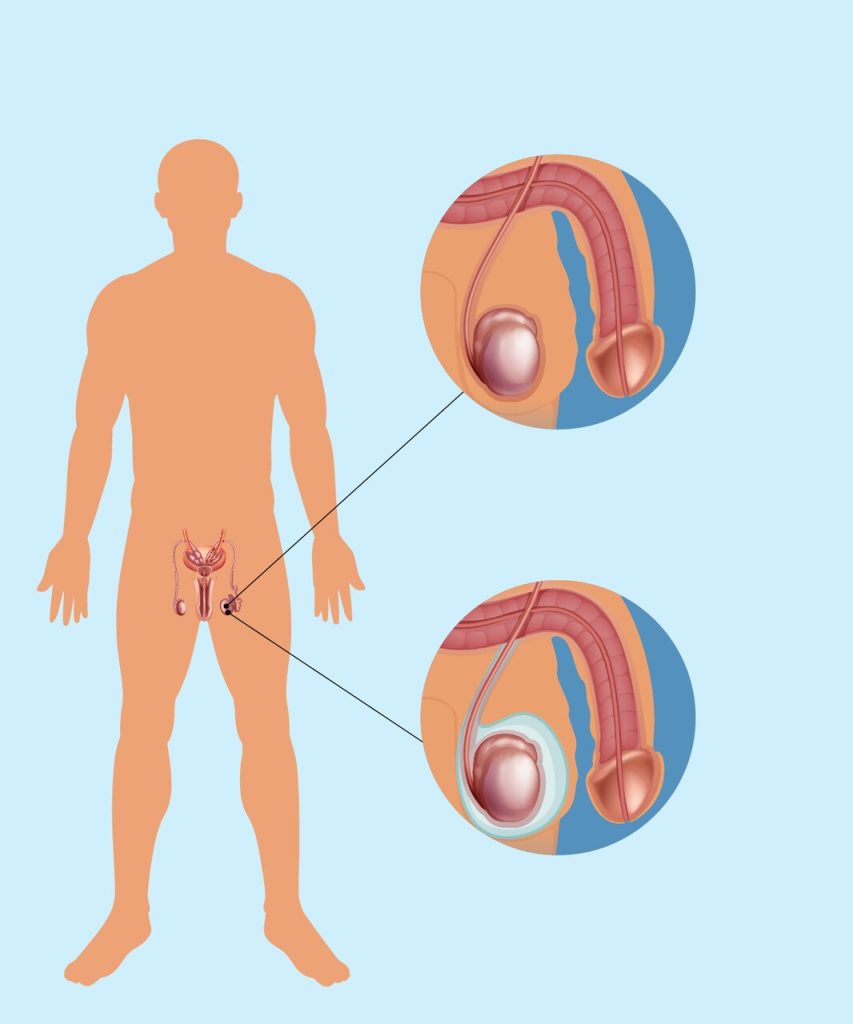 Urologia Goiânia - Quem tem hidrocele tem que operar?