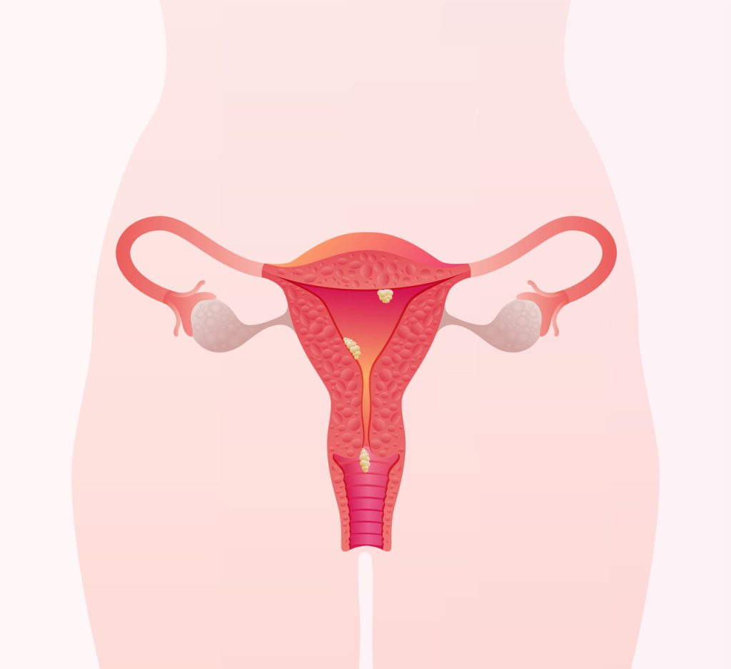 Importância de diagnosticar pólipos uterinos que acometem 40% das mulheres!