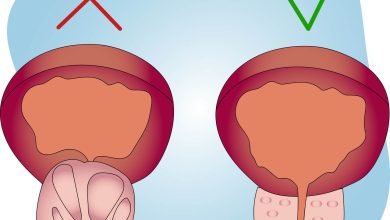Urologia Goiânia - Tipos de cirurgias para tratamento da hiperplasia de próstata