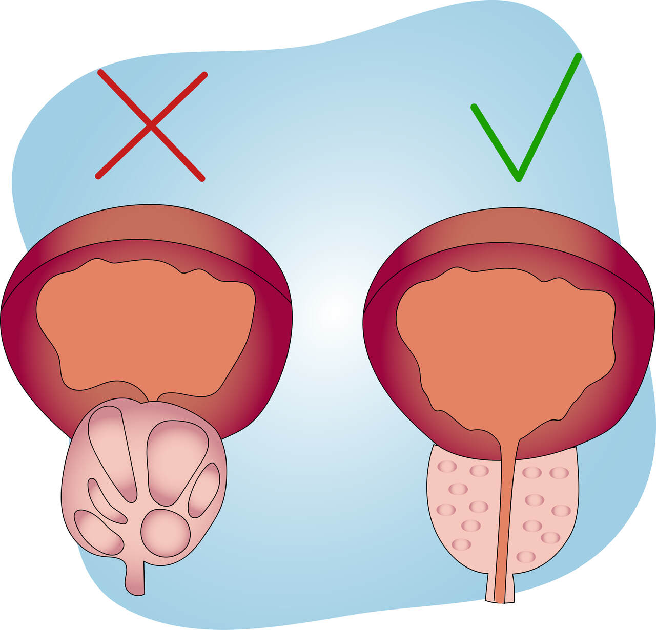 Urologia Goiânia - Tipos de cirurgias para tratamento da hiperplasia de próstata
