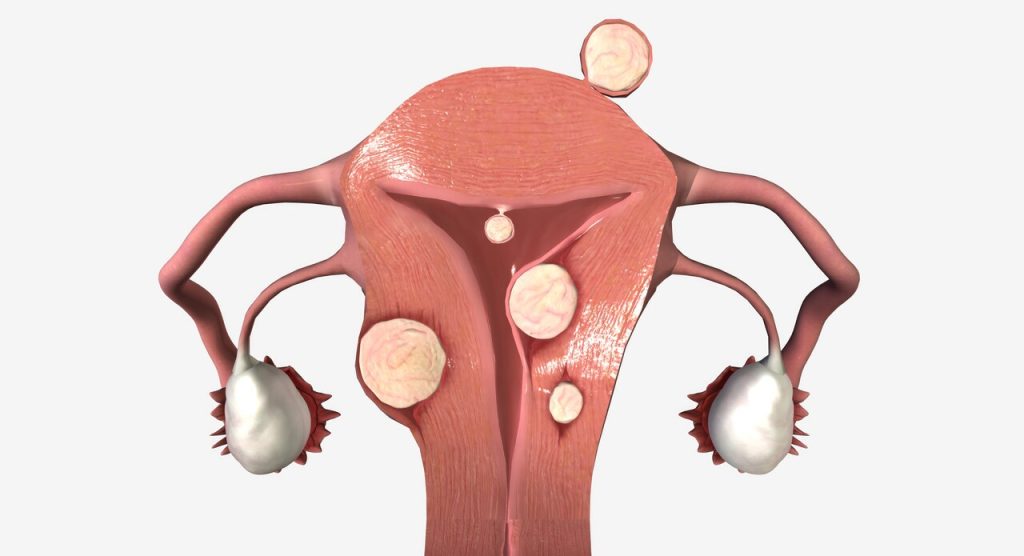 Posso ter miomas no útero e não sentir nada?