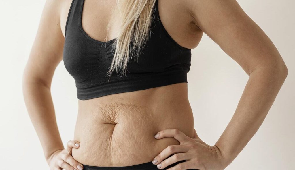 Goiânia - Tenho diástase abdominal, é indicado a abdominoplastia?
