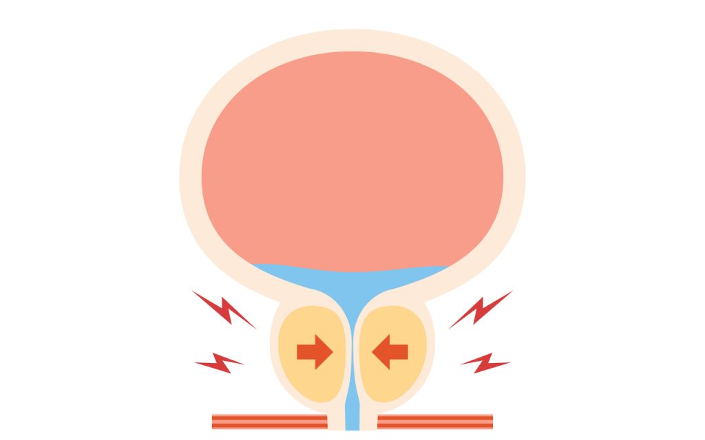 Conheça o Holep, a cirurgia a laser altamente eficaz no tratamento da hiperplasia benigna da próstata