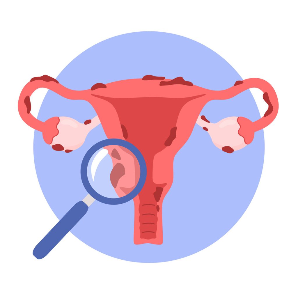 Ultrassonografia transvaginal e sua importância no diagnóstico da endometriose