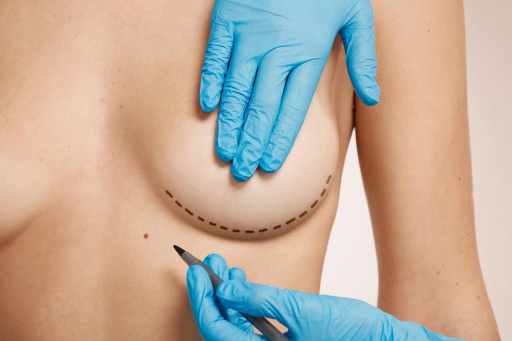 Dr. Reyner Abrantes Stival: Tipos e Formatos de Implantes Mamários - O Que Você Precisa Saber