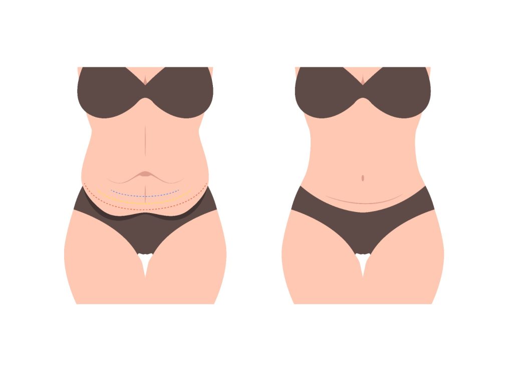 Você sabe a diferença entre abdominoplastia e mini abdominoplastia?