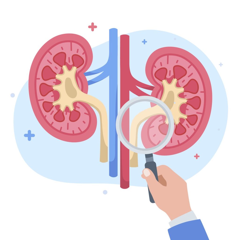 É possível quebrar cálculos renais sem precisar de cirurgia?