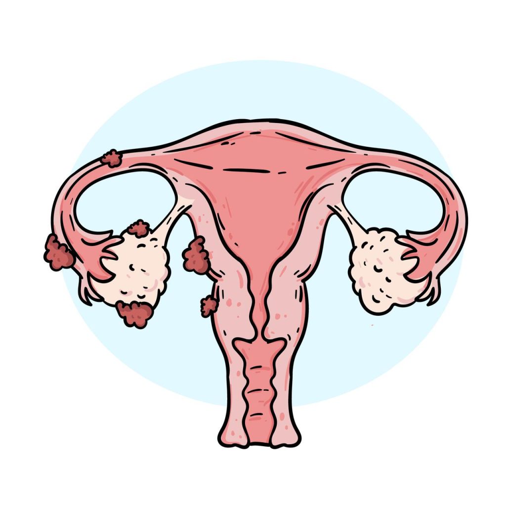 Centro de Imagem Aparecida de Goiânia - Como é feito o mapeamento de endometriose?