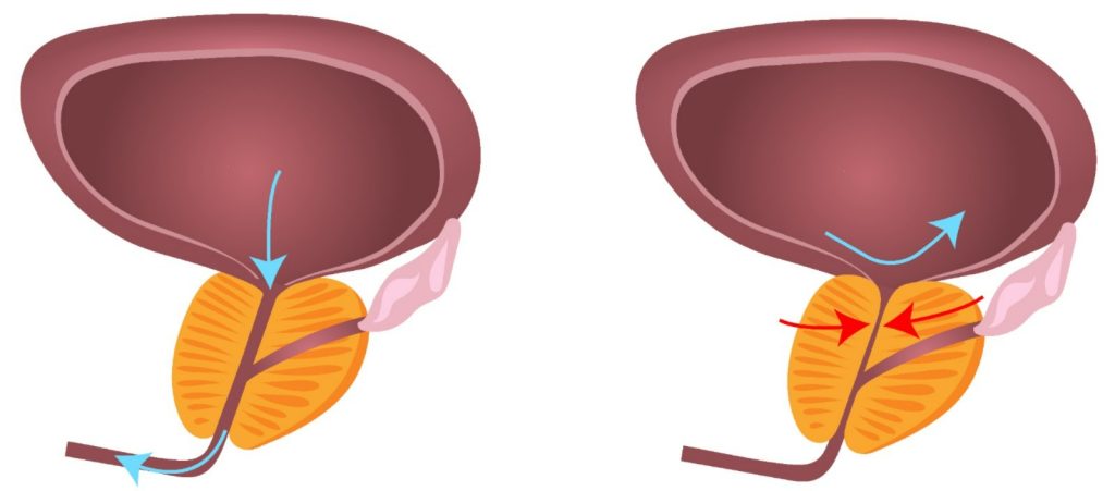 HoLEP: A Solução Definitiva para tratar próstatas de todos os tamanhos!