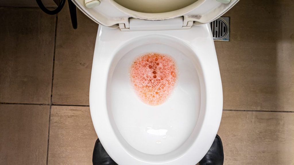 Alerta Vermelho: Sangue na urina pode ser sinal de tumor na bexiga?