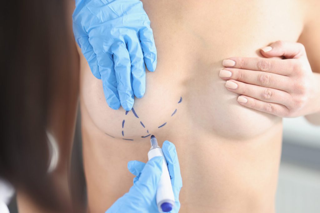 Como saber se meu caso a indicação é mastopexia ou prótese de silicone?