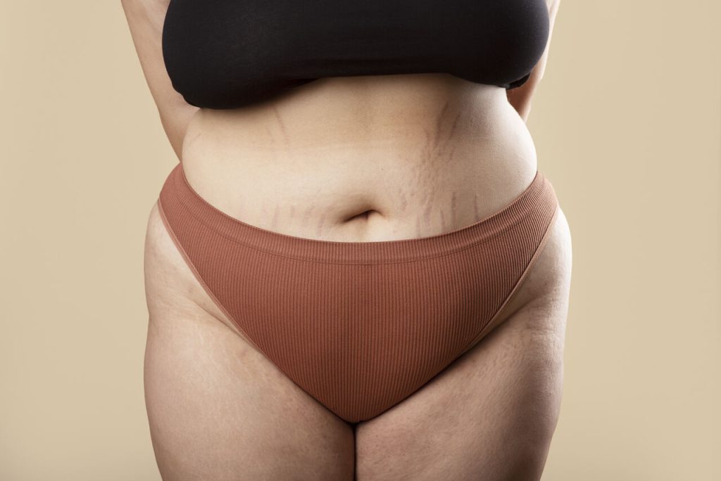 A abdominoplastia remove estrias?