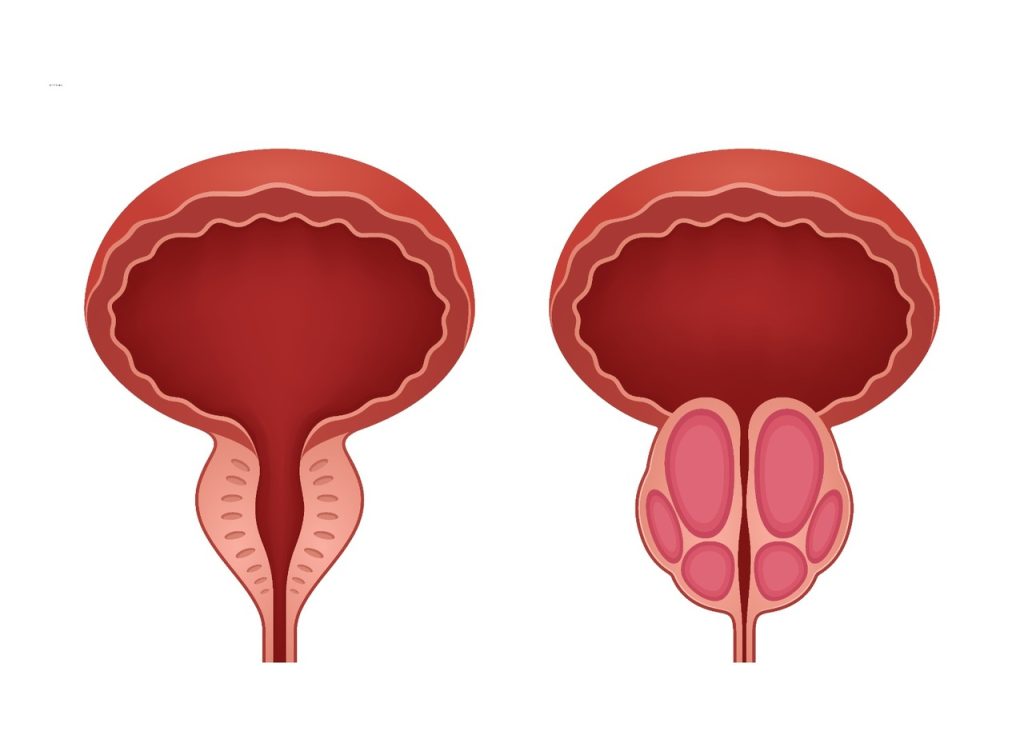 Como diferenciar câncer de próstata e Hiperplasia Prostática Benigna (HPB)?