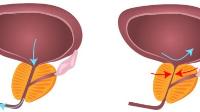Câncer de próstata X Hiperplasia prostática benigna