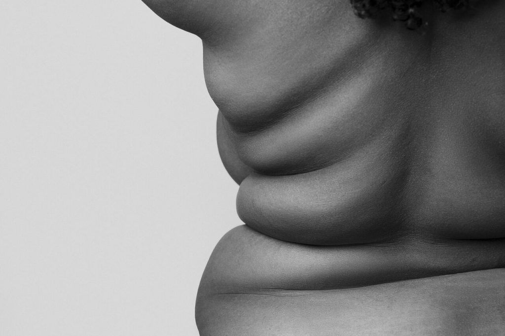 Cirurgia plástica e obesidade