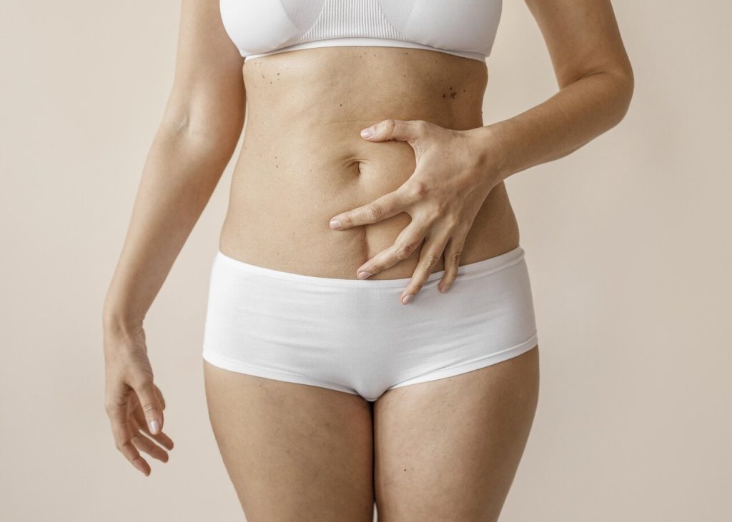 Dr. Reyner Abrantes Stival - Para que serve a órtese de umbigo na abdominoplastia?