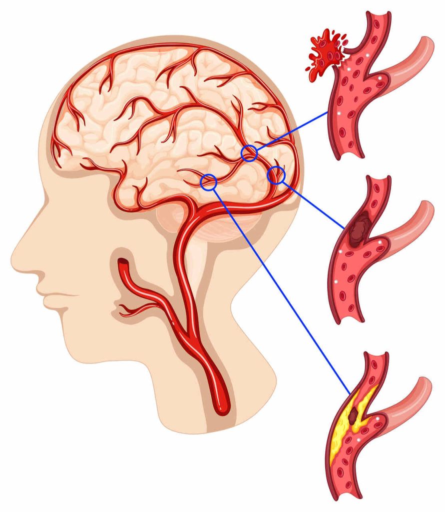 Dr Matheus Bannach Neurocirurgião Goiânia - Aneurisma cerebral: o que é, quais os sintomas e tratamento?