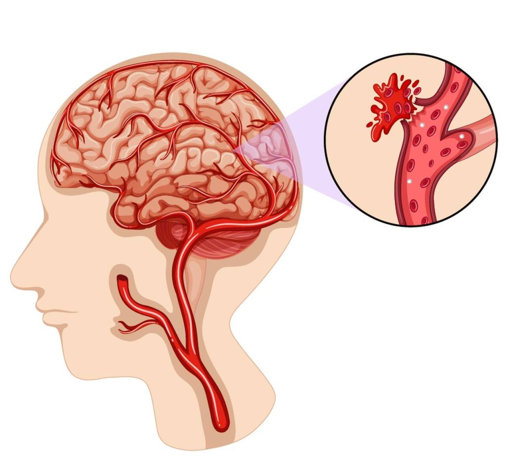 Dr Matheus Bannach Neurocirurgião - Como descobrir se tenho aneursima cerebral
