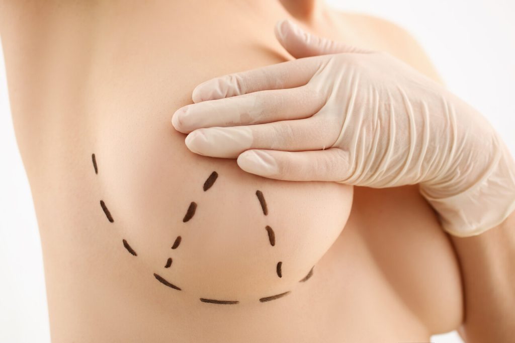 Cirurgia plástica Goiânia - Tem como diminuir a cicatriz da mastopexia?