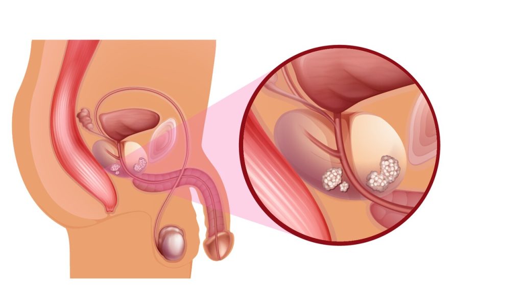 Prostatectomia: entenda quais são os tipos e quando é necessária!