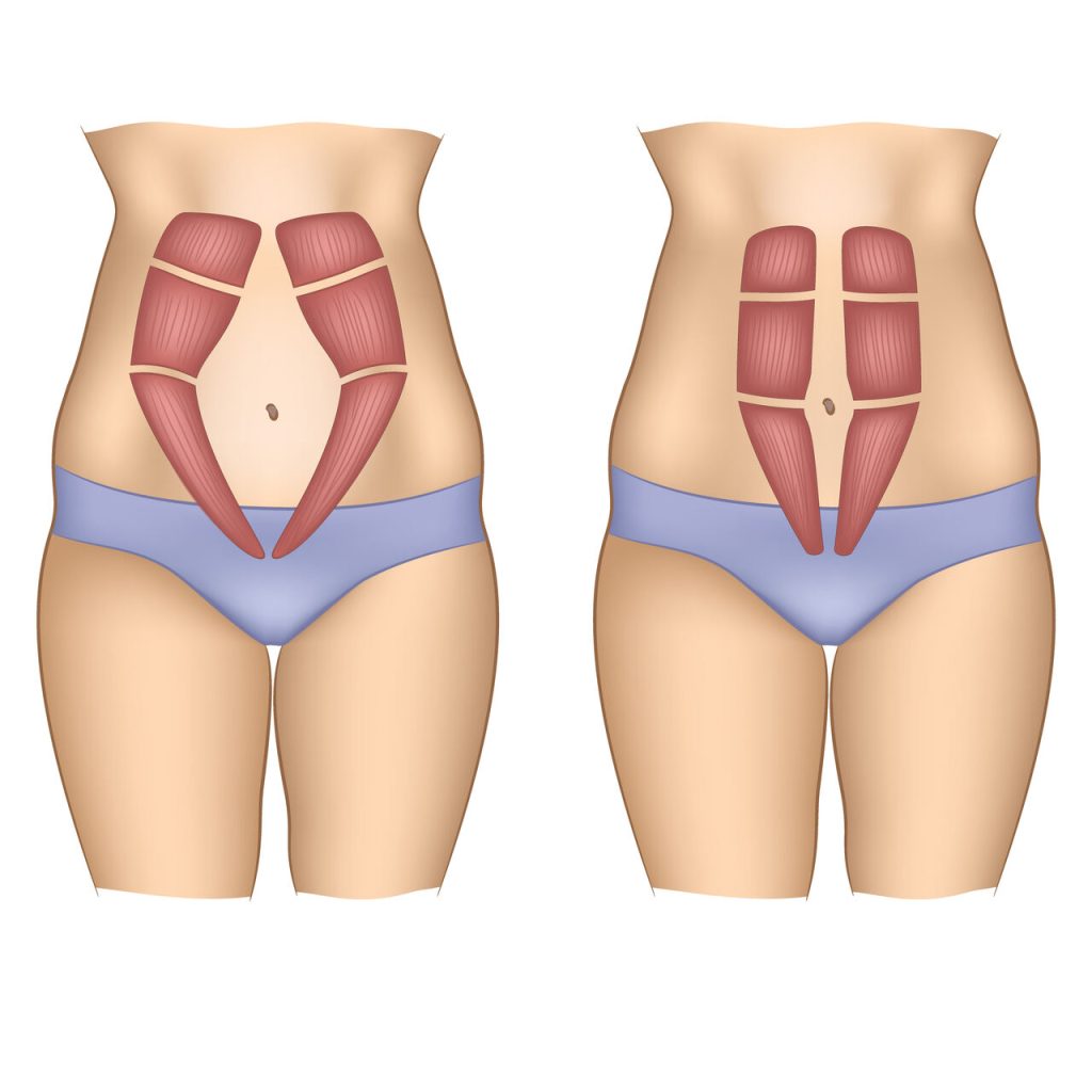 Cirurgia plástica Brasília: É possível corrigir a diástase abdominal sem realizar uma abdominoplastia completa?