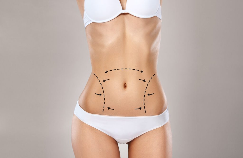 É possível fazer abdominoplastia e mastopexia juntas?
